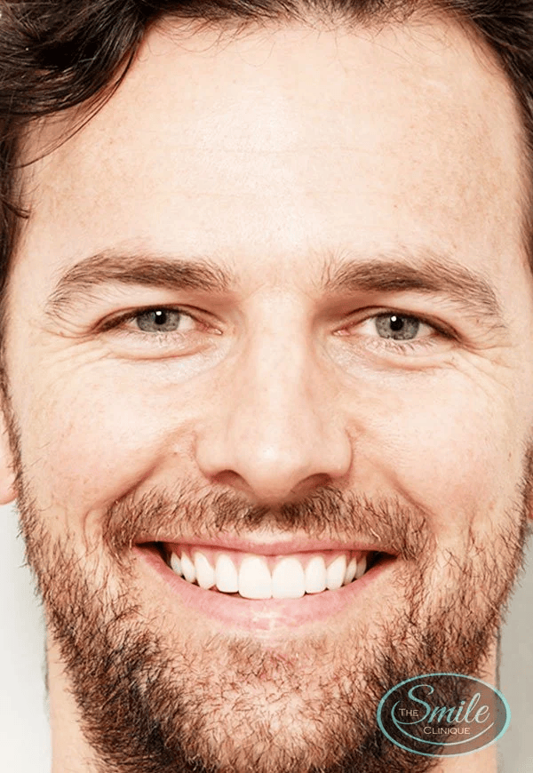 Teeth Straightening Perth